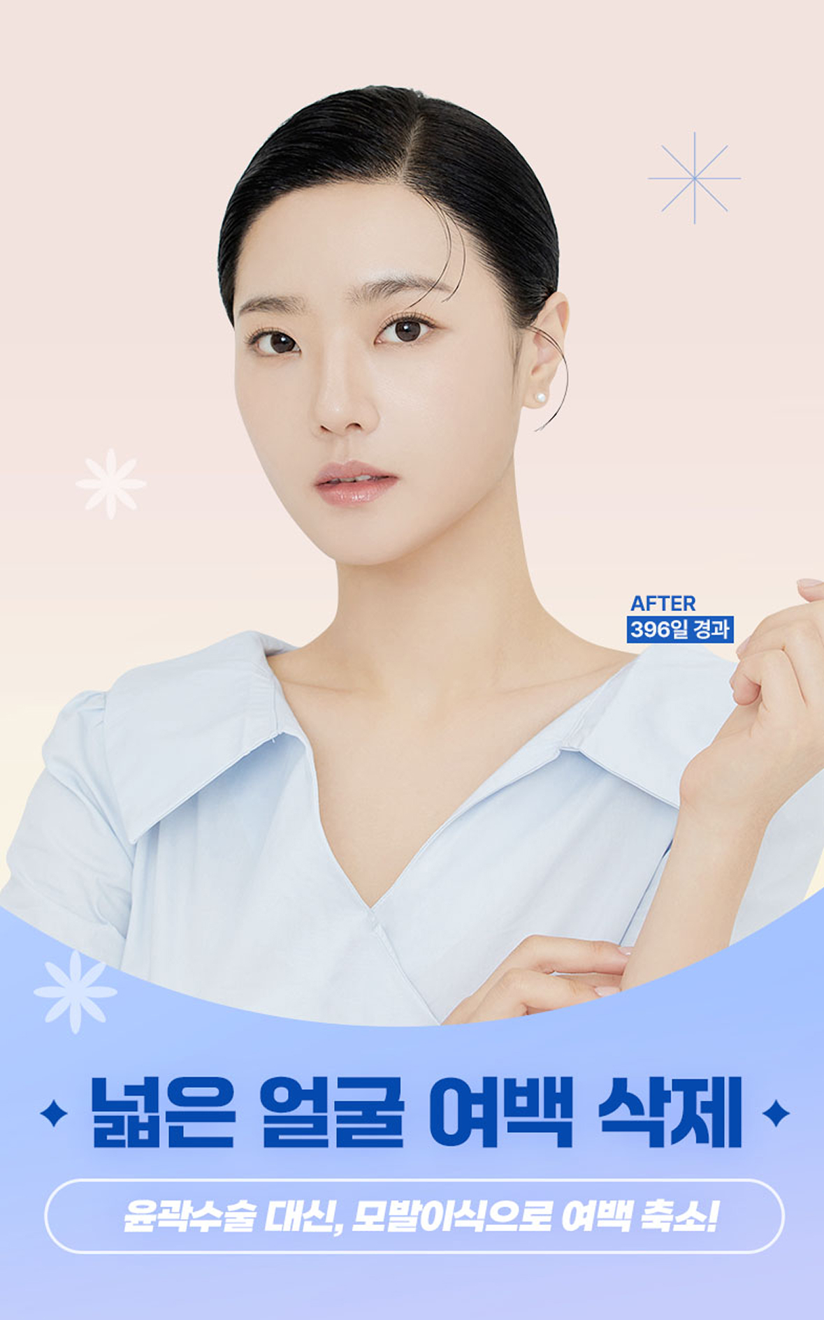 넓은 얼굴 여백 삭제! 윤곽수술 대신, 모발이식으로 여백 축소!