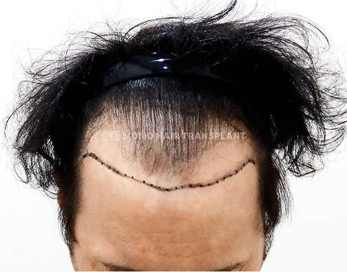 남성 절개 모발이식 before