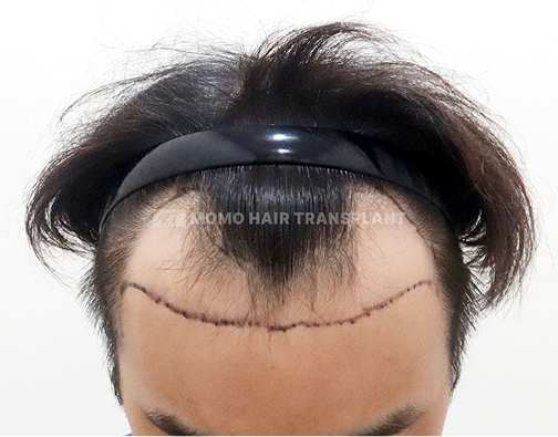 남성 절개 모발이식 before