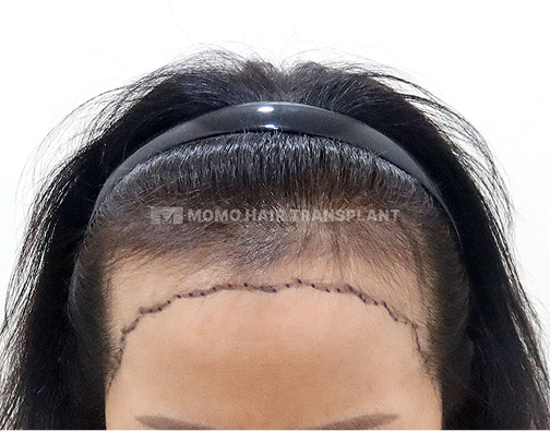 여성 절개 모발이식 before