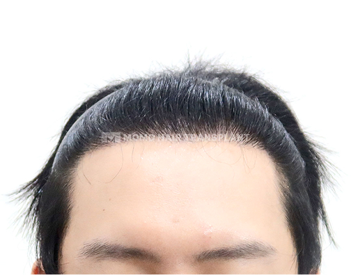 남성 비절개 모발이식 after